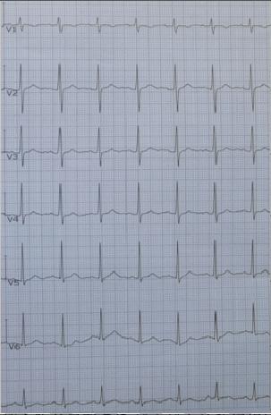心电图诊断口诀图解,判读心电图的正确方法