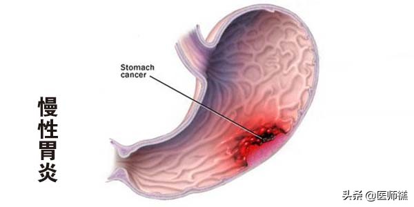 胃炎久治不愈查肿瘤标志物正常,胃炎一直拖着不治