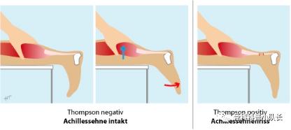 打篮球崴脚怎么处理热敷还是冷敷,崴脚超过48小时是热敷还是冷敷