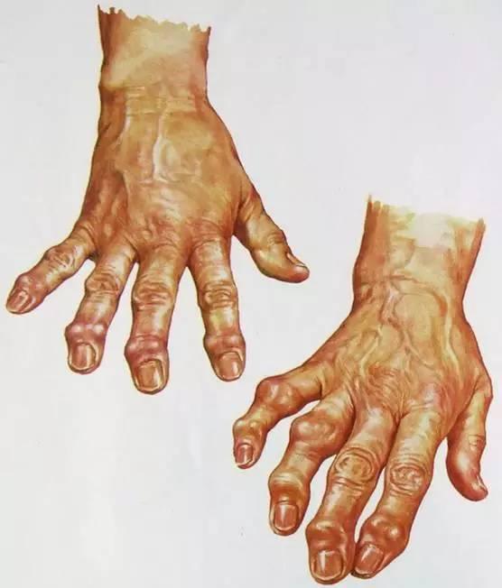 风湿类风湿关节痛广告原版,关节痛是痛风还是风湿