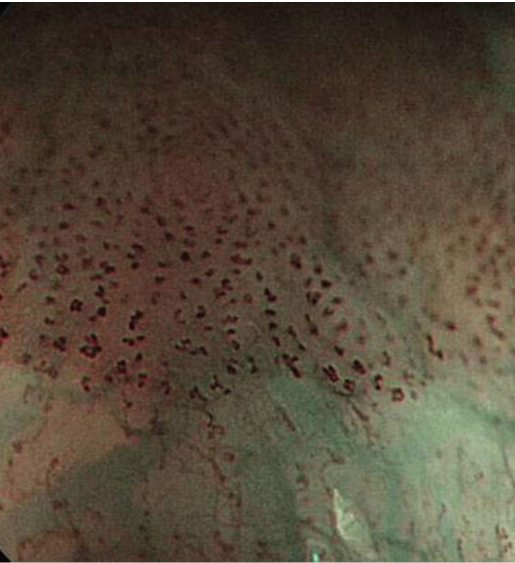 食管癌早期做胃镜能查到吗,食管癌通过胃镜可以检查出来吗