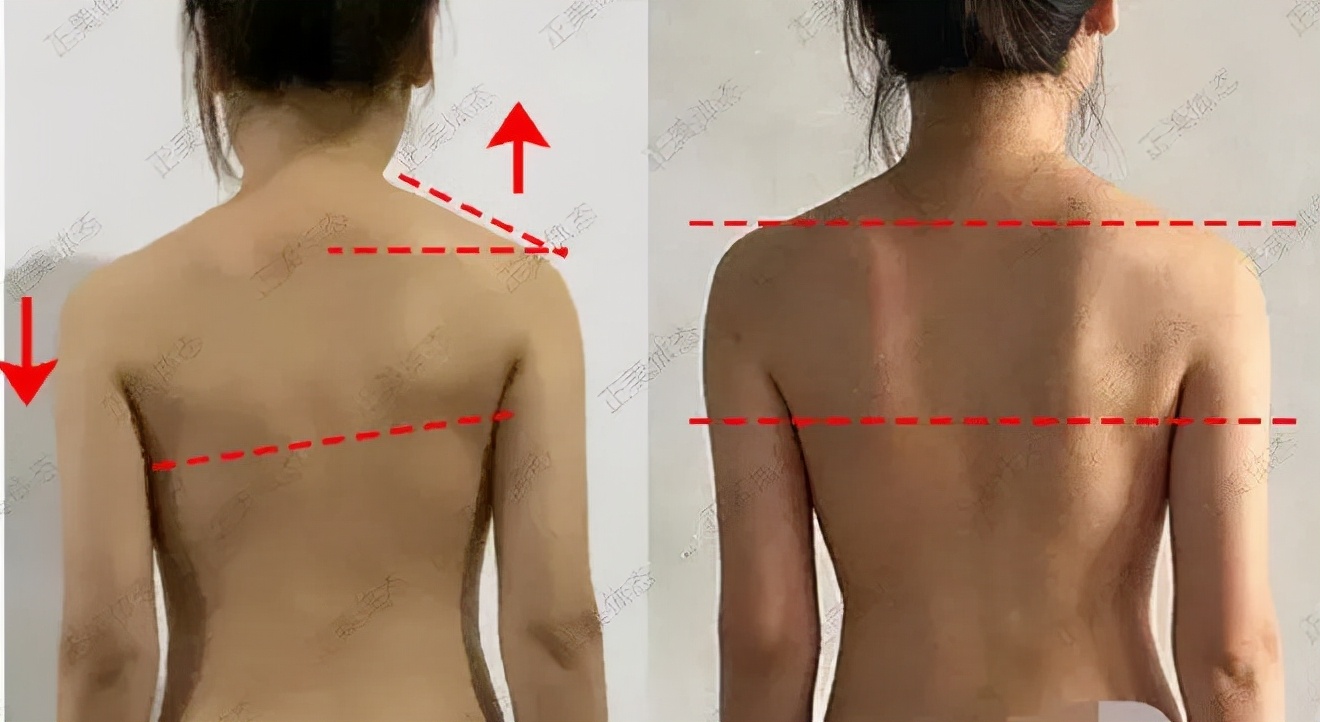 瑜伽高低肩矫正训练动作,偏瘫高低肩矫正训练动作