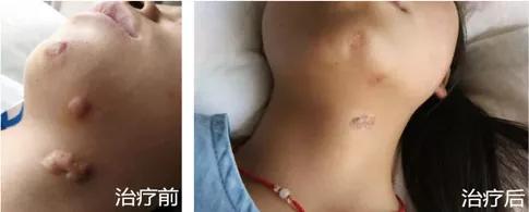 「掌健识」可恶的瘢痕疙瘩，你知道怎么去掉吗？