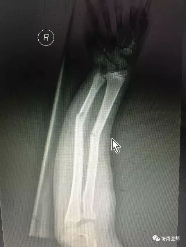 孩子骨折了一定要做打钢针手术吗,儿童摔伤骨折需要手术么