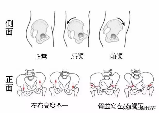 纠正骨盆歪斜消除肚腩操,骨盆歪斜会造成骨盆旋转吗