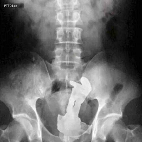 不作死就不会死，看看这些被人类搞进身体里的异物