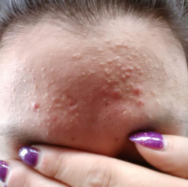 痘痘肌化妆教程化妆品,痘痘肌化妆需要哪些化妆品