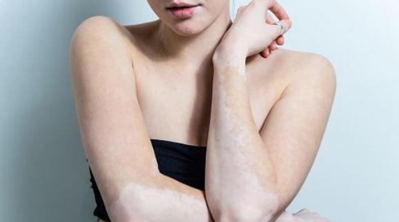 白癜风治疗省钱妙招,白癜风怎样治疗比较省钱又有效