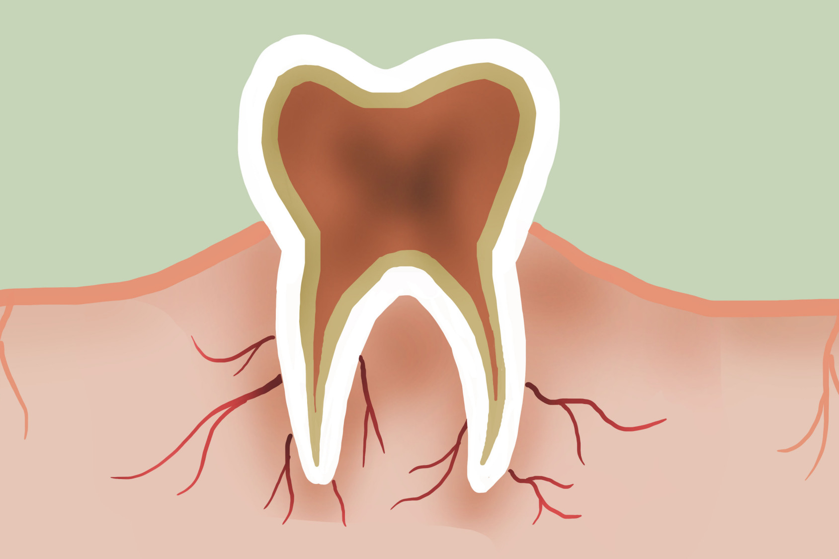 没有牙结石洗牙的清理步骤,自己在家洗牙去牙结石
