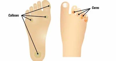 前脚掌疼痛,前足疼