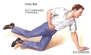 健康科普知识常见骨折防御知识,桡骨远端骨折健康宣教科普知识