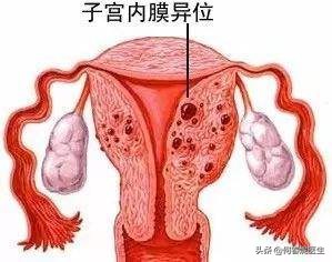 曼月乐能治疗妇科炎症吗,曼月乐有避孕效果吗