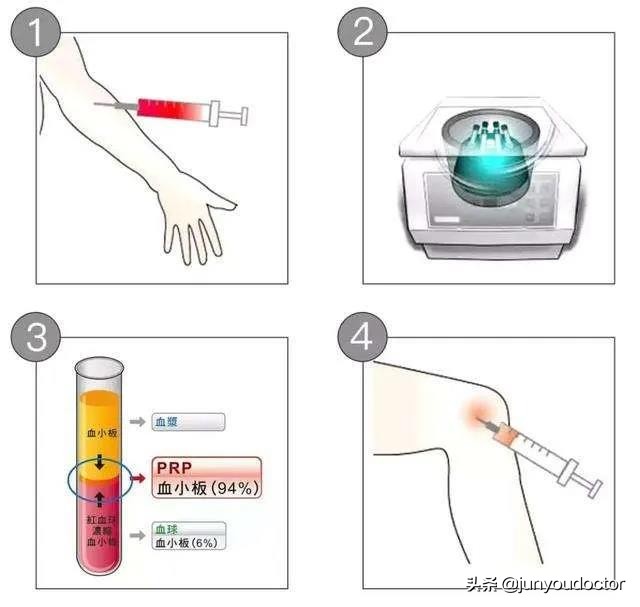 我(PRP)的超能力是富予人体超强自愈力