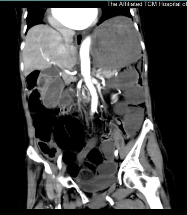 新冠心绞痛腹痛怎么办,突发严重胸痛警惕主动脉夹层