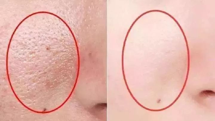 脸上螨虫多出油厉害怎么办,脸上有螨虫痘还痒该怎么办