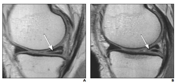 半月板损伤为什么医生不建议手术,半月板损伤诊断结果