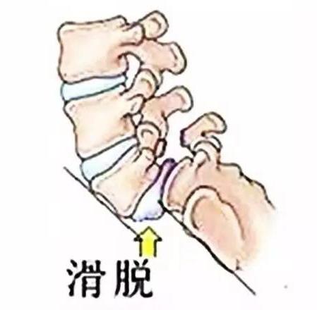 腰椎滑脱症状和治疗,腰椎滑脱推拿手法及注意事项