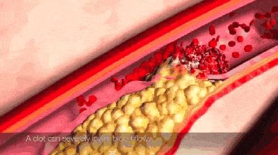 为什么高血压是无形的杀手,高血压是无形杀手吗