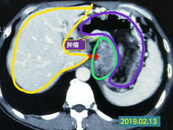 胃癌肝和肺有结节是转移了吗,胃癌扩散到淋巴和肝脏能手术吗