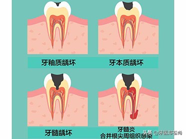 蛀牙严重到什么程度需要根管治疗,7岁小孩蛀牙很严重要怎么治