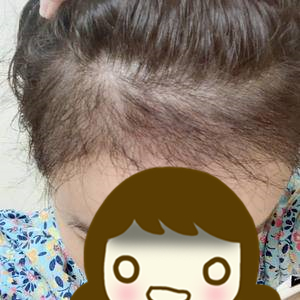 发际线太高怎么办初中生,发际线太高怎么办学生党