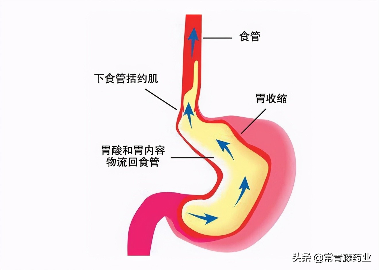 儿童胃食管反流饮食如何调理,胃食管反流引起咳嗽饮食注意什么