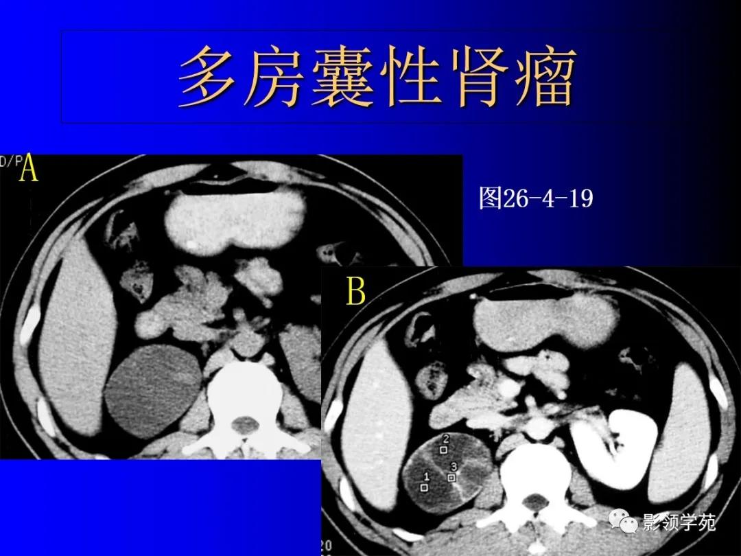 肾脏囊性肿块的影像学特点,肾脏典型病理图片及解析