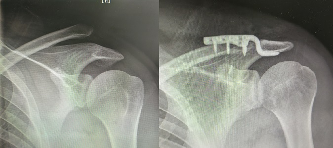 肩锁关节脱位复位视频,肩锁关节脱位固定带