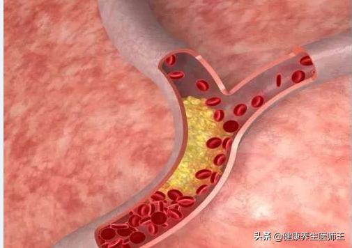 生命健康有哪些方面,临床症状脑血栓形成