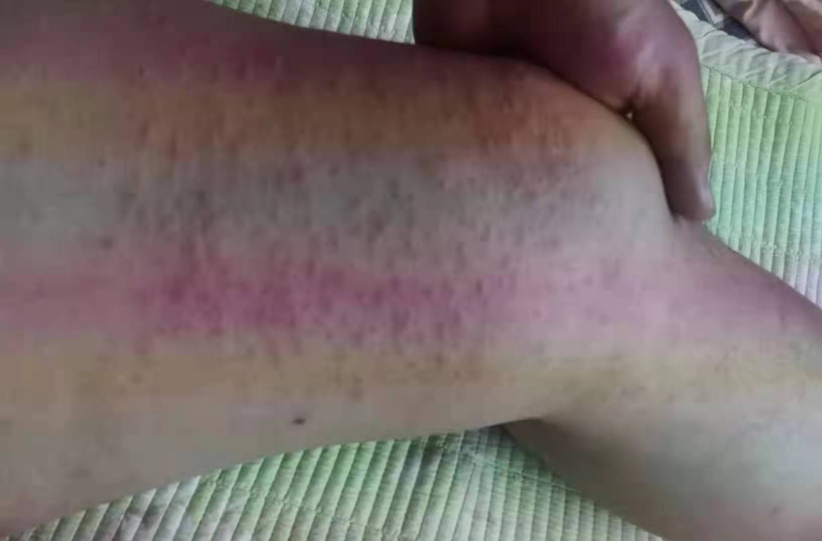 接触性皮炎和肝脏有没有关系,接触性皮炎不治疗会扩大吗