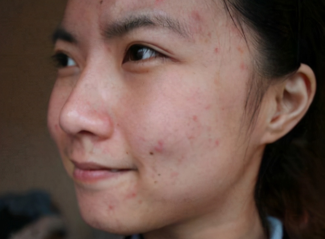 18岁脸上长痘的少女用什么护肤品,30多岁脸上反复长痘用什么护肤品