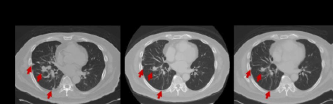 braf基因突变甲状腺癌,braf突变肺腺癌免疫治疗效果
