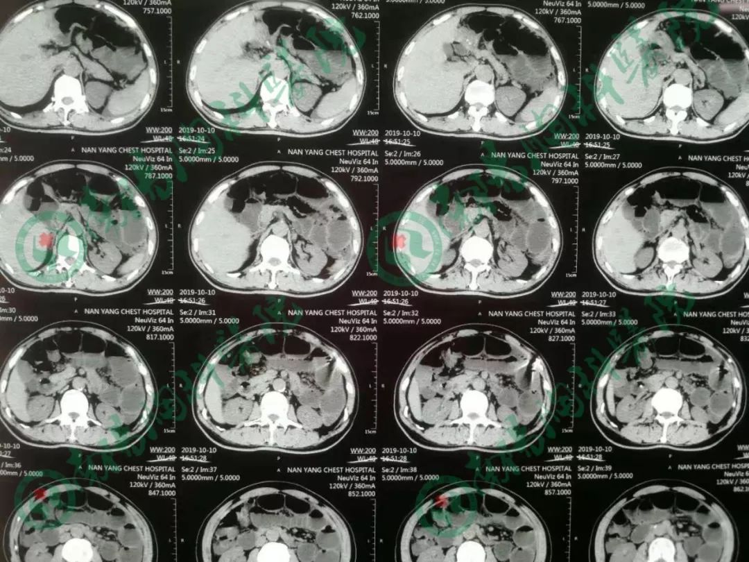 南阳胸科医院治疗直肠癌患者病例