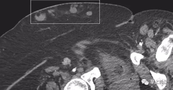 腹壁病变诊断思路,腹部影像诊断读片入门视频