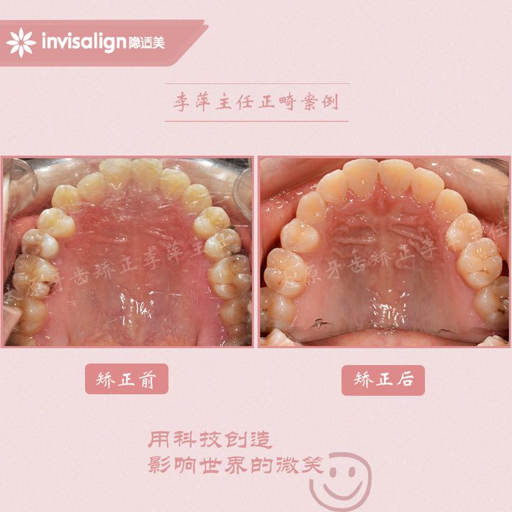 太原矫正牙齿需要做正颌吗,太原牙齿二次矫正