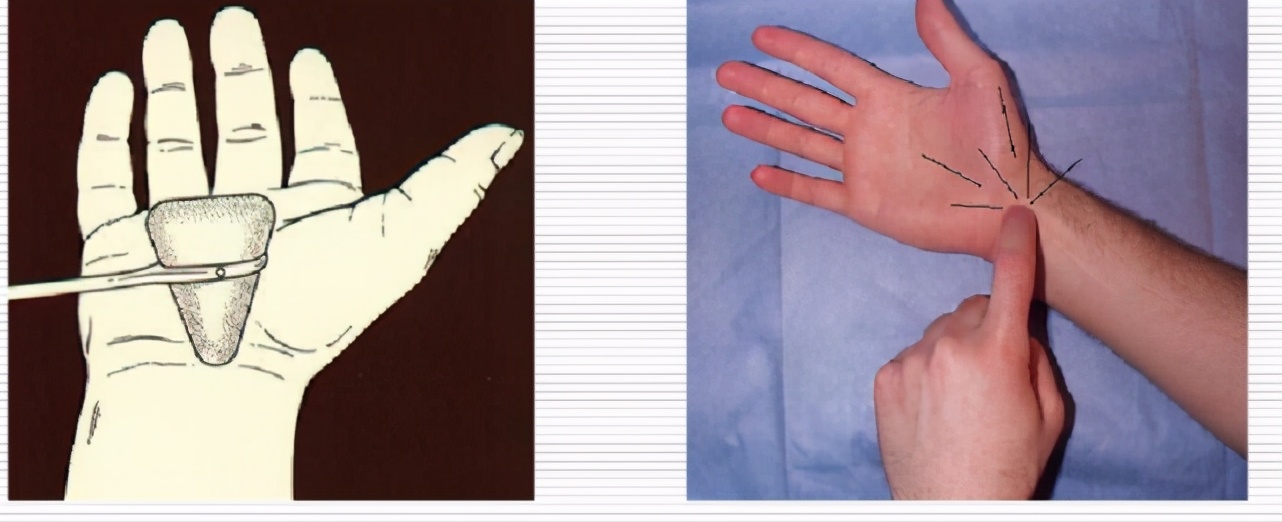 颈椎病晚上睡觉经常手麻怎么回事,颈椎病每天晚上睡醒了手麻严重吗