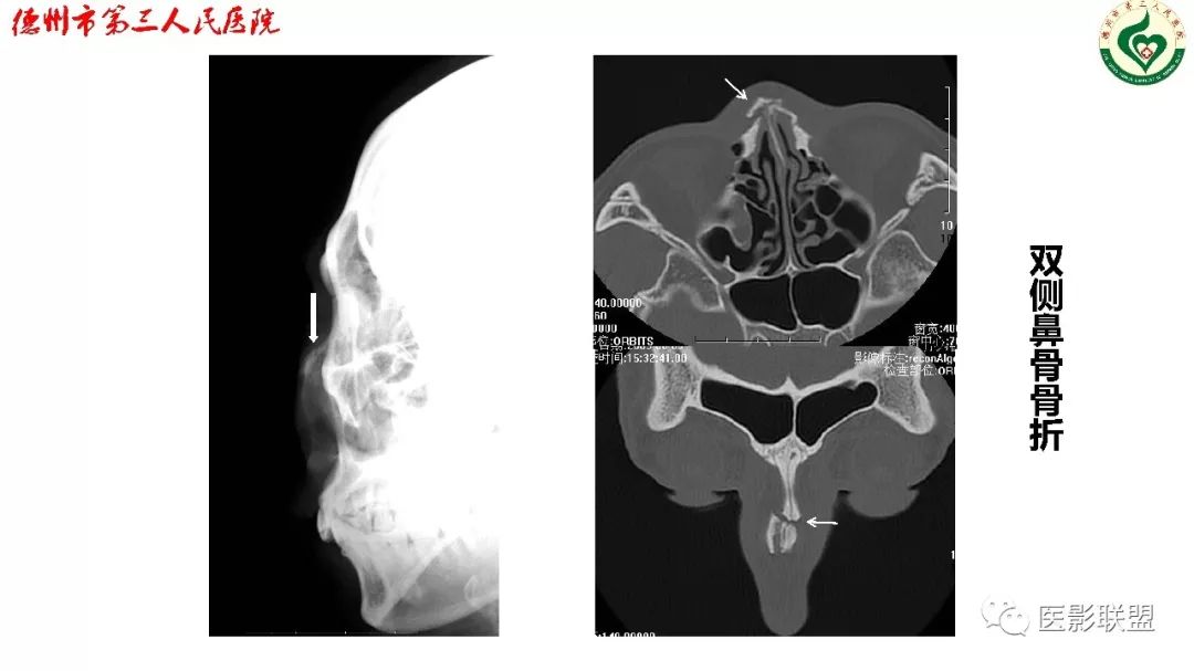 鼻骨骨折影像,鼻骨骨折dr影像表现