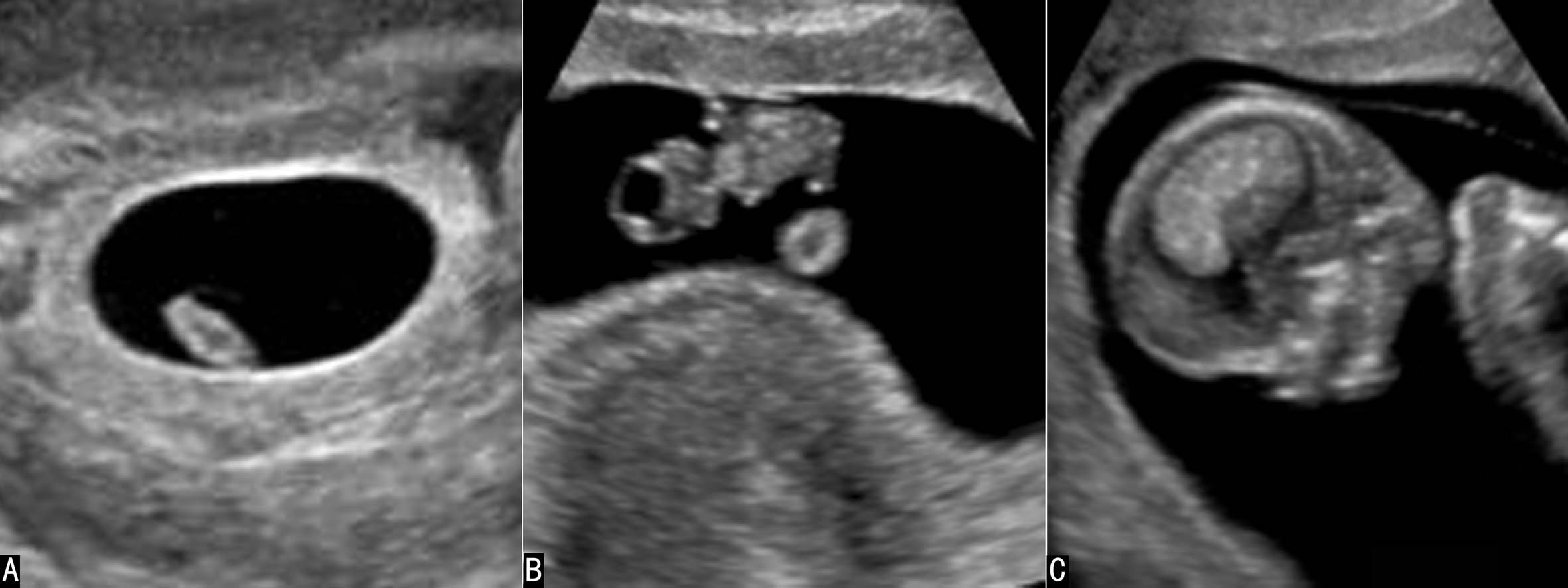 明明白白做超声(十九):羊水和胎膜超声检查