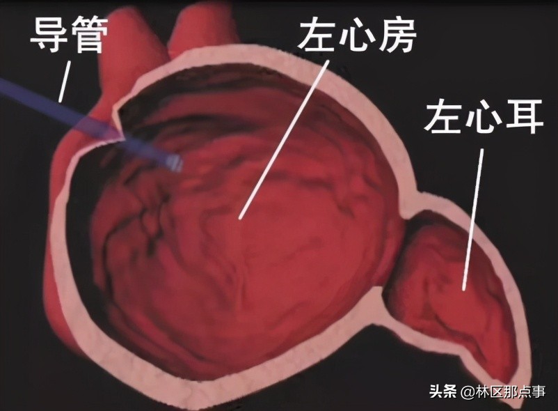 脑梗塞半边瘫手术,东北脑梗介入手术