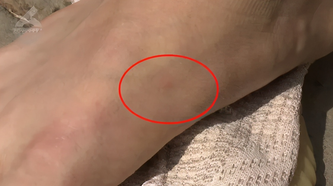 红火蚁咬到人死亡事件,红火蚁出没村民被咬出现休克