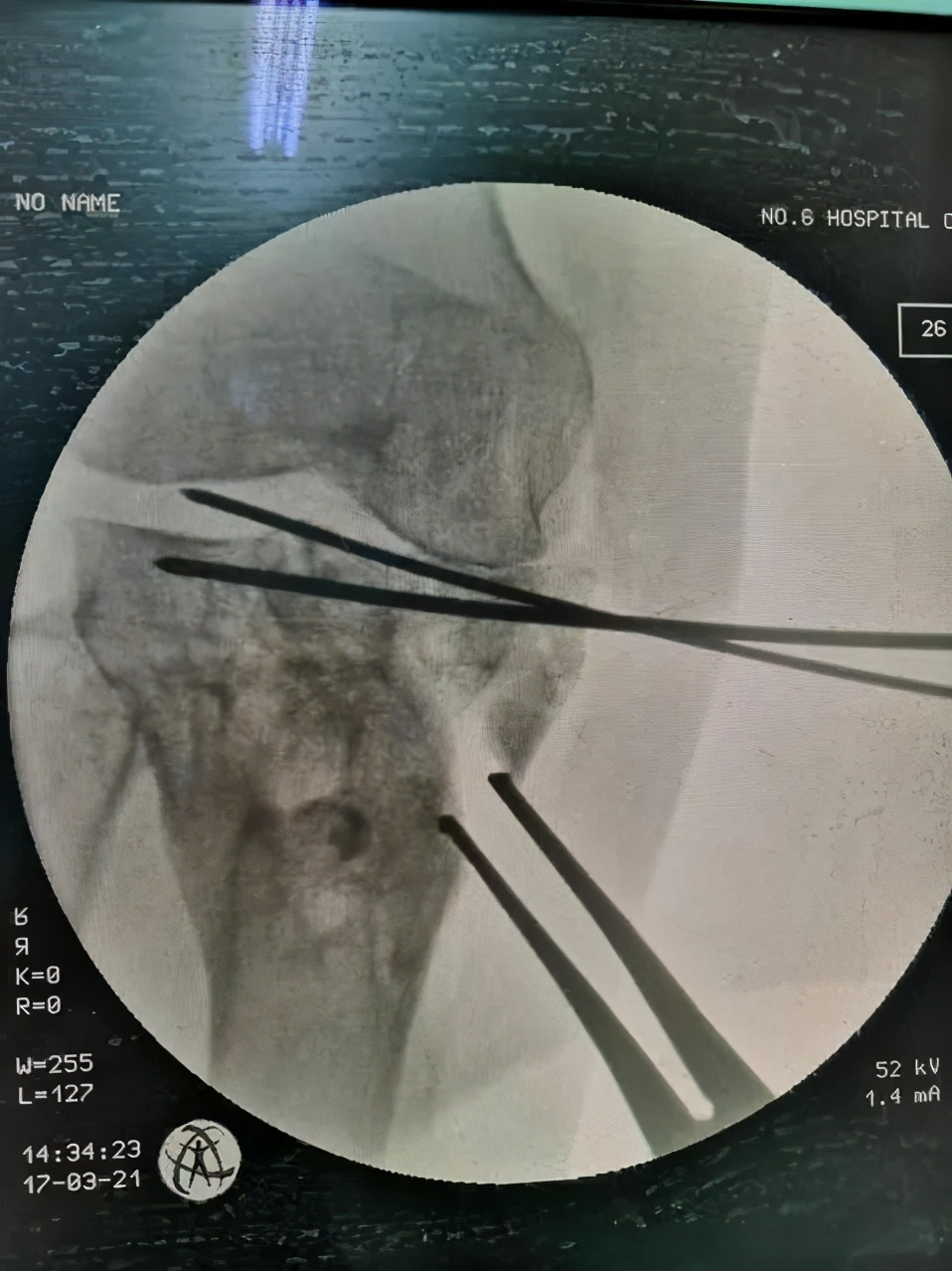 「病例精选」不用换关节，TCVO手术给您新“膝”望