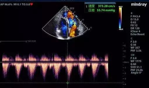 报告上写的是彩超但是是黑白图片,做彩超为什么出来的是黑白图像