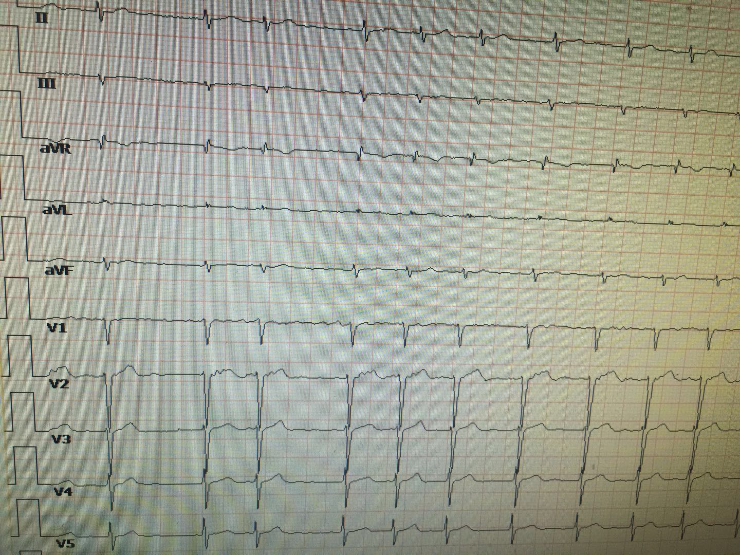 抗心律失常药教学视频,心律失常吃哪种药好