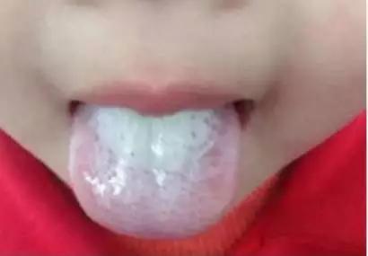 宝宝舌头地图舌是怎么回事,宝宝舌头辨别疾病图片