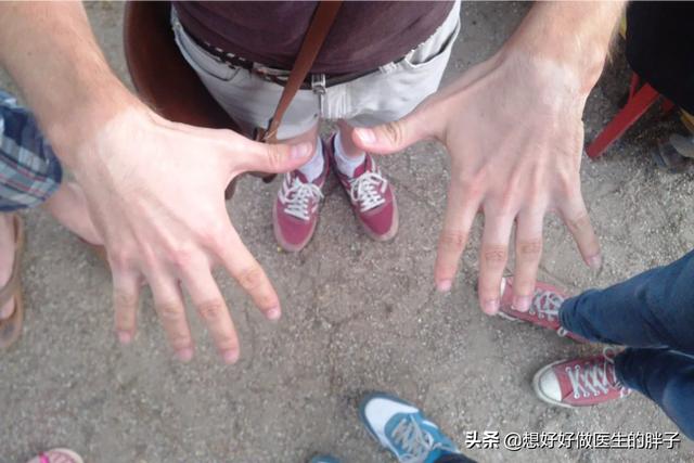 一跑步手就肿怎么回事,走路跑步身体发痒什么原因