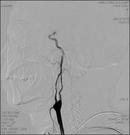 颅内覆膜支架应用于肿瘤侵袭性颈内动脉治疗