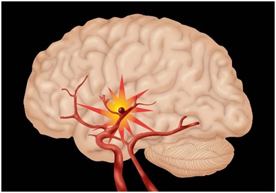 如果身边有人中风该怎么施救,身边有人晕倒怎么急救