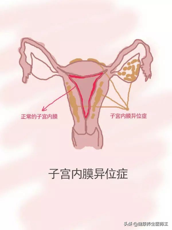 子宫内膜异位症试管,子宫内膜异位症