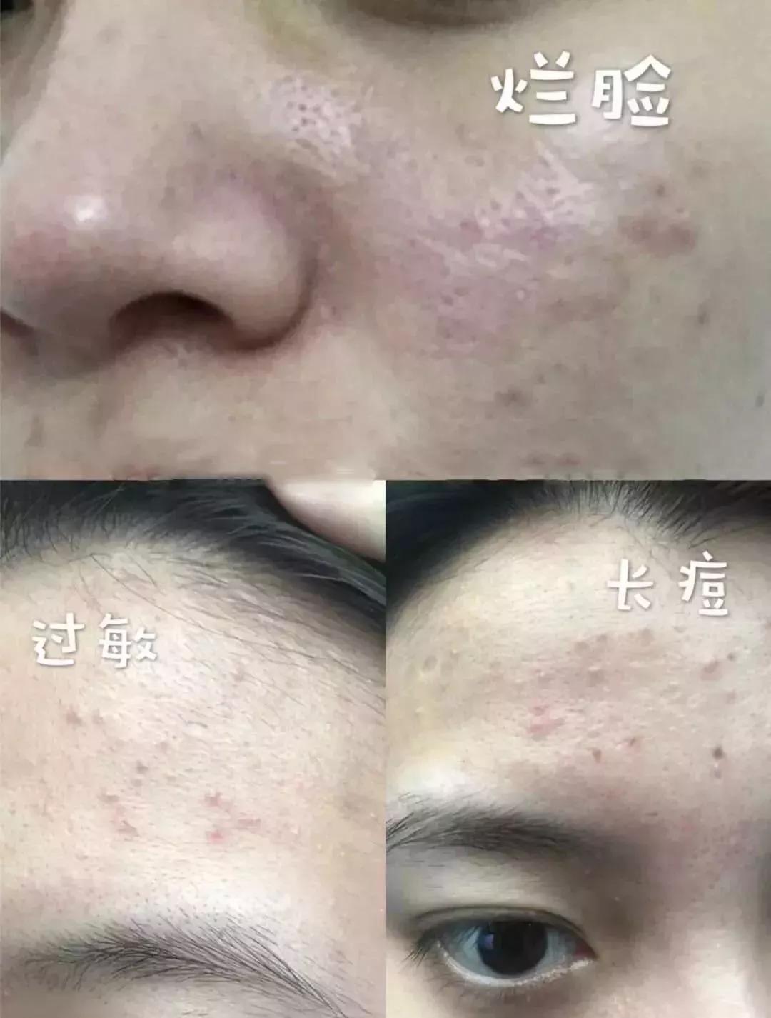 去螨虫慕斯推荐,洗面奶慕斯去螨虫