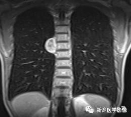 前上纵隔高密度影考虑胸腺未退化,肺纵隔胸腺结节12mm看什么科